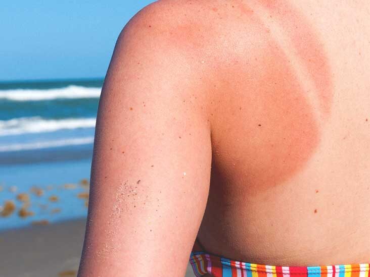 After the Sunburn